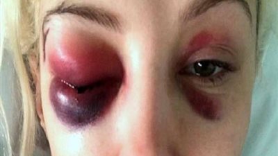 لن تصدق.. عارضة أزياء تفقد بصرها على يد خطيبها