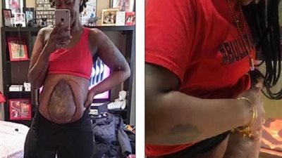 شعرت بالاكتئاب الشديد من جسدي.. سيدة تعيش بأمعاء خارج معدتها