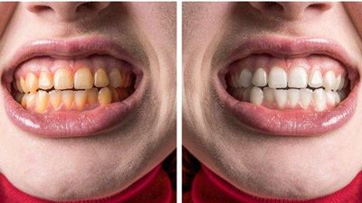 5 أخطاء شائعة في تنظيف الأسنان تفقدك ابتسامة هوليوود.. تعرف عليها