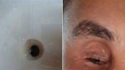 سيدة تروي تفاصيل مأساتها بعد إجراء جراحة تجميلية