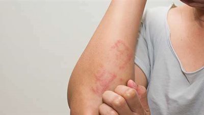 مرض غريب ونادر| أمريكي يعاني من حساسية الخضراوات