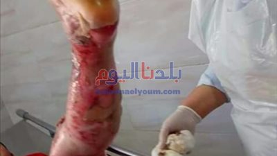 إصابة طفل بحروق إثر قيام 3 شباب بإشعال النيران في جسده بالمحلة