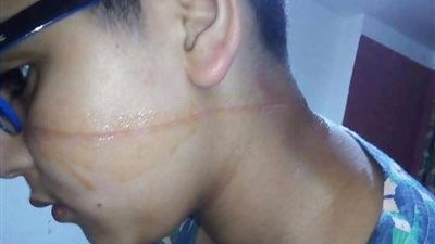 بالصور.. ضحية جديدة للطائرات الورقية في الإسكندرية