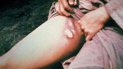 يسبب الوفاة بعد 4 أيام.. ماهو الطاعون الدبلي الذي يهدد الصين بعد كورونا