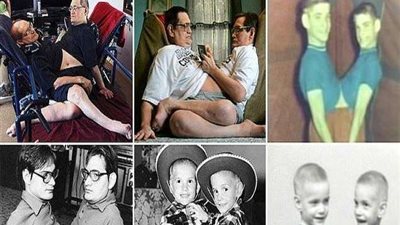 لن تصدق قصة حياتهما.. وفاة أغرب وأطول توائم ملتصق عمرًا في العالم