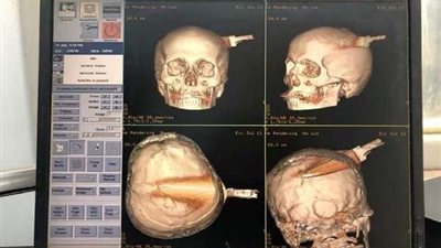 أصابت المخ.. شاب يفشل في الانتحار رغم طعن رأسه بسكين (صورة)