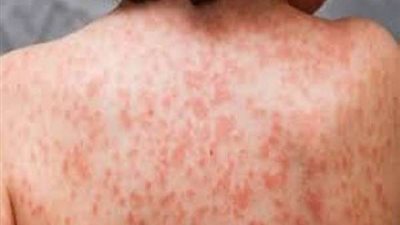 بعد إصابة أطفال تحت الـ5 سنوات.. أعراض مرض 