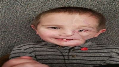 بسبب كلب.. طفل يخضع لـ عملية جراحية استغرقت 14 ساعة لإعادة بناء وجهه!