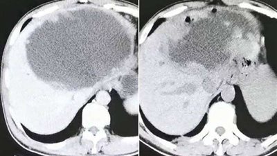 بعد تناوله وجبه غذاء.. كبد رجل تمتليء بالديدان لهذا السبب