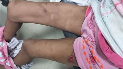 تجديد حبسِ والد طفلة قليوب المتهم بتعذيبها