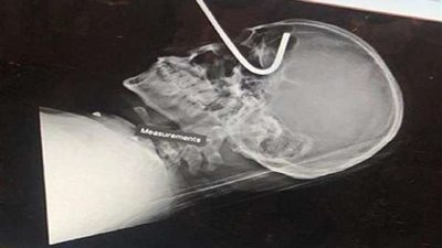 شاهد.. استخراج سيخ من جمجمة شخص بعد سقوطه من أعلى