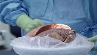 عين شمس التخصصي يعلن عن موعد إجراء أول عملية زارعة رئة من حي لآخر