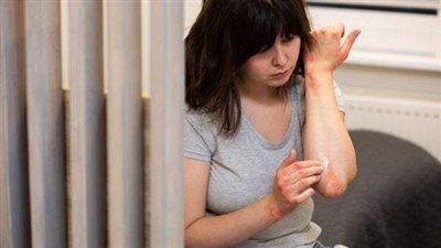 الذئبة الحمراء مرض مناعي يهدد النساء.. إليك التفاصيل