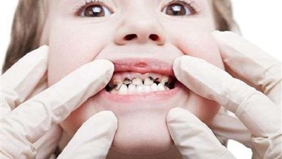 5 طرق لحماية اطفالك من التسوس.. تعرف عليها