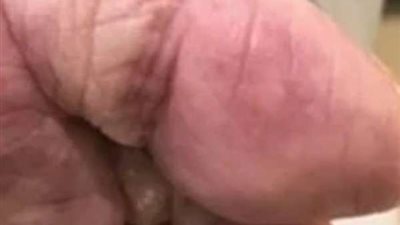 علامة تظهر على الجلد تؤكد إصابتك بفيروس كورونا