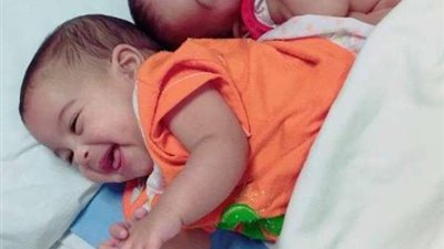 الحكومة تستجيب لإجراء جراحة لتوأمتين ملتصقتين عمرهما عام