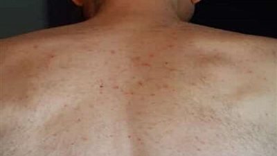 طبيب روسي يكتشف علامات جلدية قد تؤدي إلى الموت