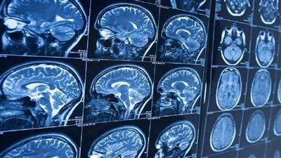 لماذا تعد السكتة الدماغية أكثر فتكا للسود؟.. دراسة تجيب