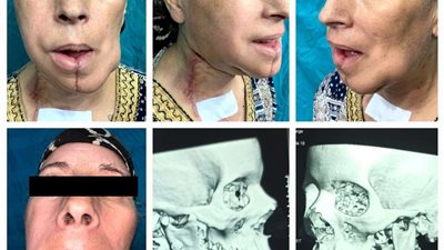 نجاح أول حالة إعادة بناء للفك بعد استئصاله لوجود ورم بمستشفيات جامعة المنوفية