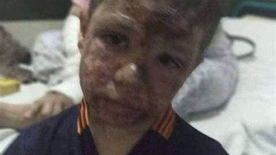 تفاصيل الحالة الصحية للمصابين التسعة في حادث إلقاء مياه نار بحفل زفاف بشبرا