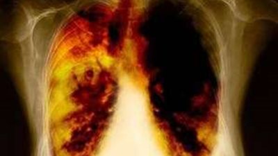 ما هي أسباب وأعراض  وطرق علاج سرطان الرئة ؟