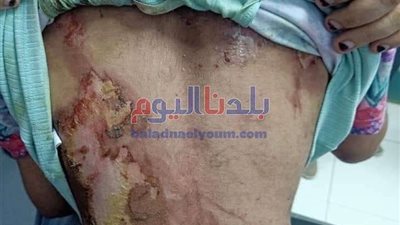 النائب العام يأمر بحبس المتهم بتعذيب الطفلة 