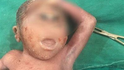 بعد 45 دقيقة.. وفاة طفل الأقصر المولود بـ