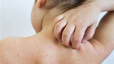 عاد من جديد .. تعرف على أعراض جدري القرود