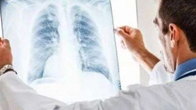 استشاري أمراض صدرية: الصعوبة في التنفس من أعراض الالتهاب الرئوي الخطير