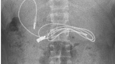 شاهد .. استخراج وصلة شاحن من معدة شاب تركي
