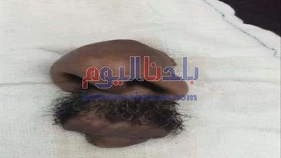 بالصور.. جراحة عاجلة لشخص قطعت أنفه وشفتيه في المحلة