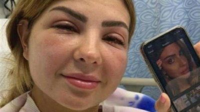 شاهد.. خطأ في عملية تجميل يشوه وجه مدونة شهيرة