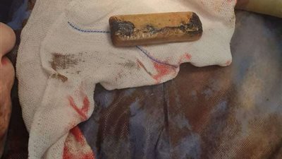 استخراج هاتف من معدة مواطن بمستشفى بنها الجامعي