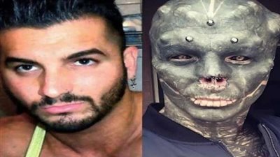 شاب يتحول إلى كائن فضائي بعد إزالة أنفه.. صور