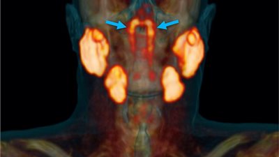 باحثون يتوصلون إلي عضو غامض كامن في مركز رأس الإنسان!