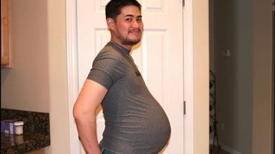 بعد شعوره بالتعب.. الأطباء يشخصون حالة رجل بالحمل