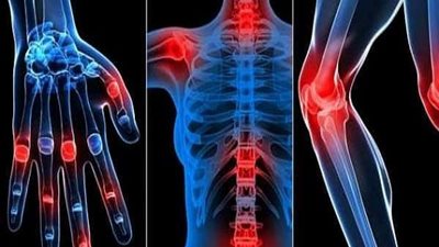 في اليوم العالمي للروماتيزم.. إليك أعراضه وطرق علاجه