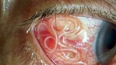 بعد عام.. استخراج 20 دودة حية من عين رجل