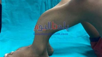 اصلاح أعوجاج فى الطرفين السفليين لطفل بالغربية