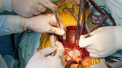 جراح: زراعة القلب أبسط من الجراحات العادية ونسب نجاح الشرايين التاجية 98%
