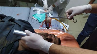 بلع سمكة صاحية.. إنقاذ مريض في مستشفى بني سويف النموذجي (صور)
