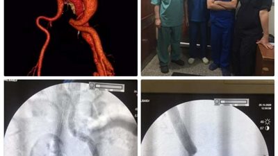 فريق طبي بجامعة أسيوط ينجح في إجراء عملية معقده ونادرة على مستوى العالم