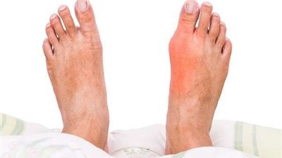 العامل الوراثي.. كل ما تود معرفته عن النقرس والنظام الغذائى له