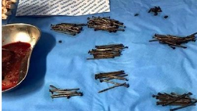 أغرب عملية جراحية.. استشاري يكشف تفاصيل استخراج 230 مسمار وزجاج من بطن مريض