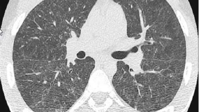 مرض خطير وغامض يصيب عائلة بأكملها بسبب حوض الاستحمام الساخن