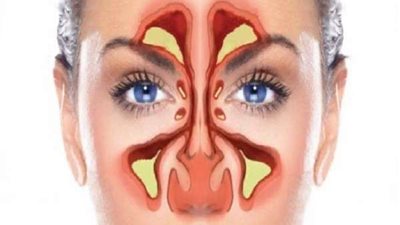 10 نصائح لمرضى الجيوب الأنفية.. تعرف عليها