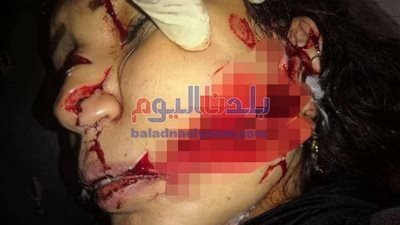 زوج يمزق وجه زوجته بسلاح أبيض انتقاماً منها بالعربية (صور)