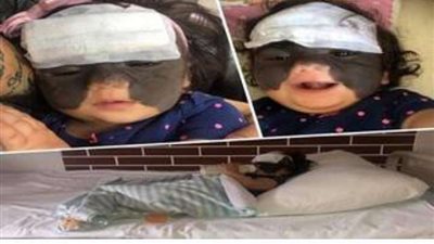 باهظة الثمن.. تفاصيل نجاح إزالة 