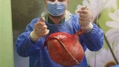 استئصال ورم يزن 10 كيلو جرام من رحم سيدة بمستشفى بنها الجامعي