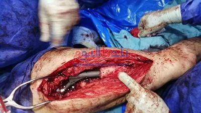 مستشفى بني سويف الجامعي ينجح في زراعة مفصل فخد صناعي كامل لمريض